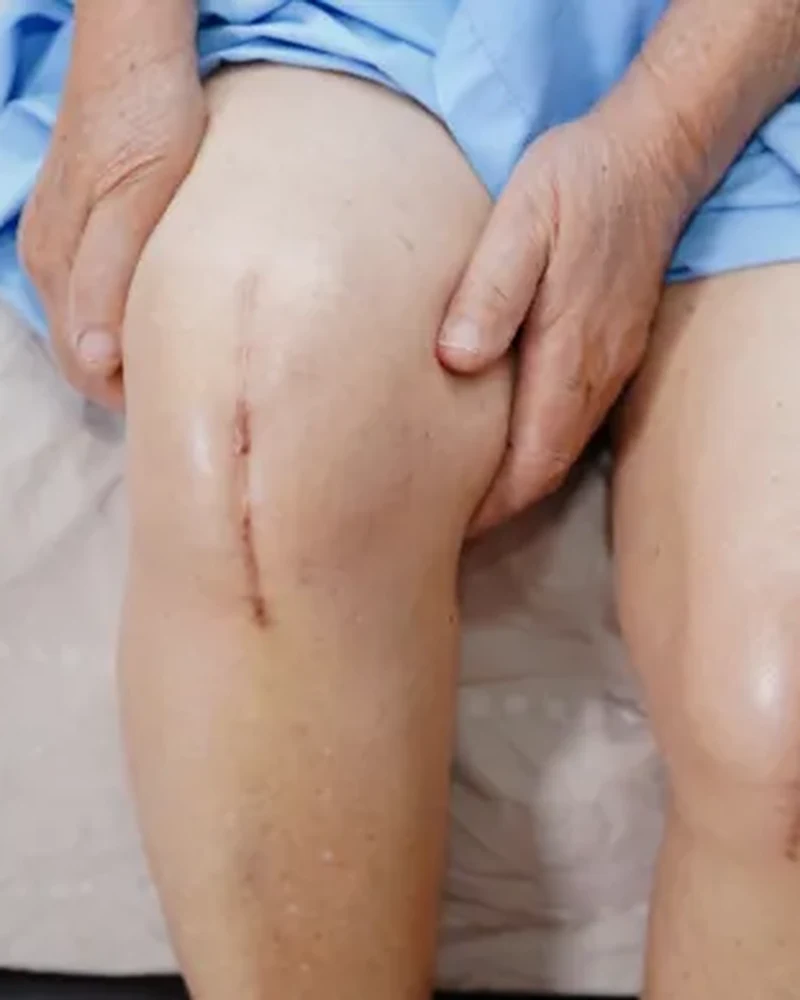 Therapist helping a patient regain knee bend after replacement surgery