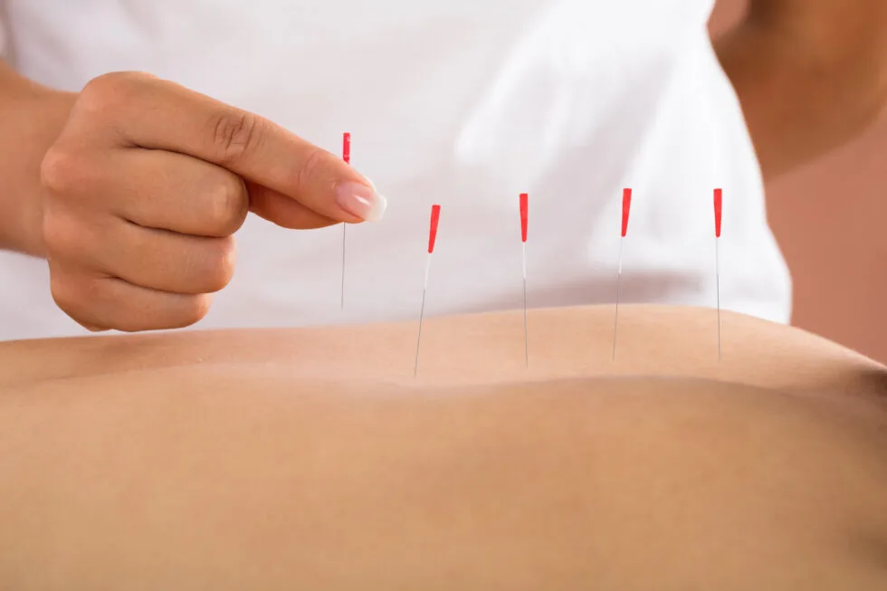 Dry Needling by a Physical Therapist: What You Should Know